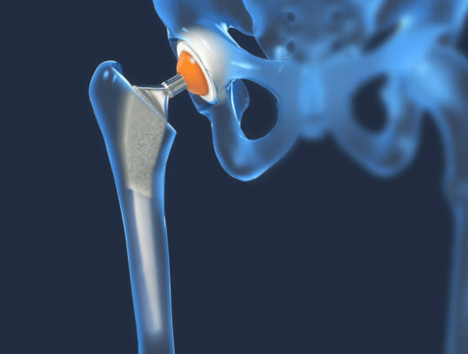 What Is a Hip Replacement? | GlobMed